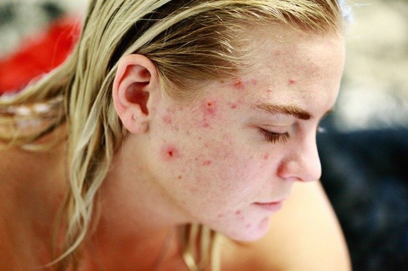 Brufoli e acne: gli errori da evitare e cosa fare per eliminarli