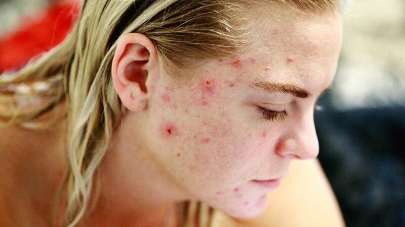 Brufoli e acne: gli errori da evitare e cosa fare per eliminarli
