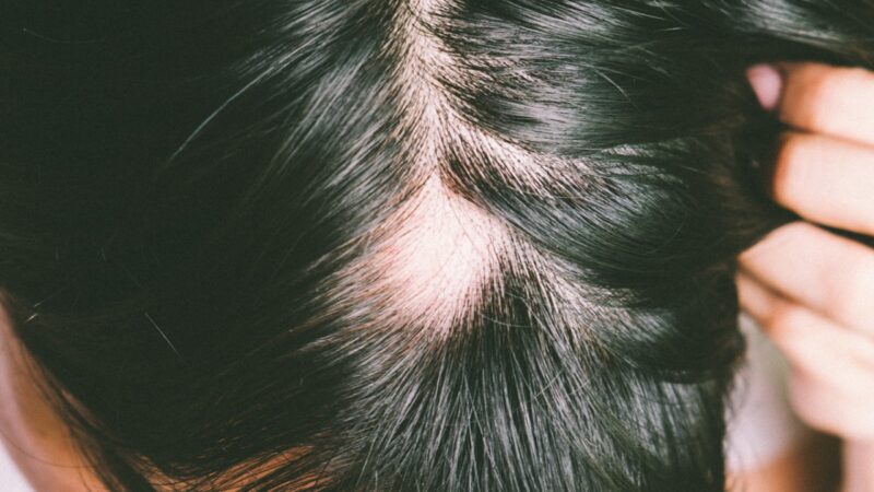 Alopecia e diradamento maschile: tipologie e cause