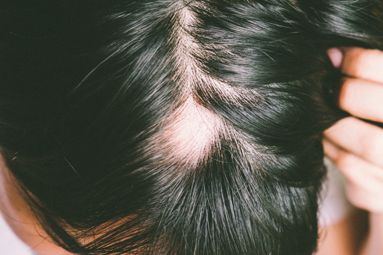 Alopecia e diradamento maschile: tipologie e cause